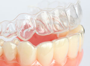 Straighten Your Teeth Discreetly - Blog - Sparkle Dental - affordable-invisible-braces