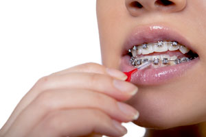 How To Clean Your Braces - Blog - Sparkle Dental - cleaning-braces