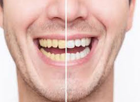 Avoid Staining Your Teeth After Teeth Whitening - Blog - Sparkle Dental - stained-teeth-whitening